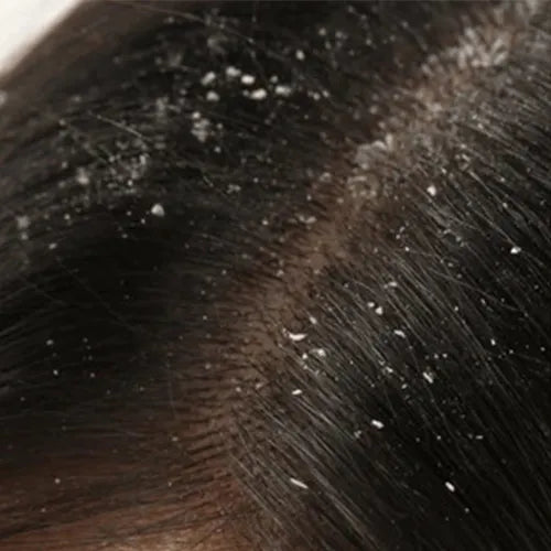 Hair_Dandruf_Before