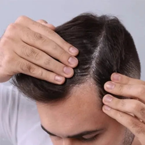 Hair_Dandruf_Before