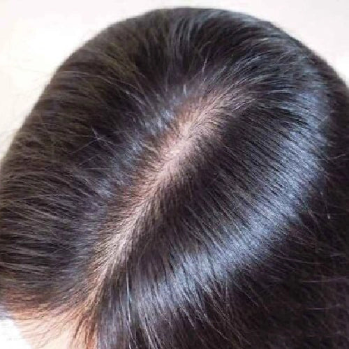 Hair_Dandruff_After