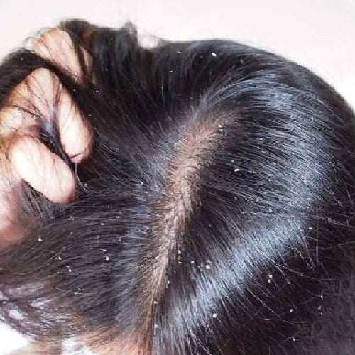 Hair_Dandruff_before