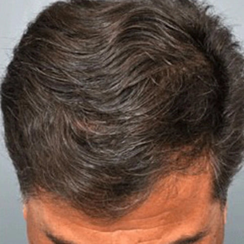 Hair_Fall_After