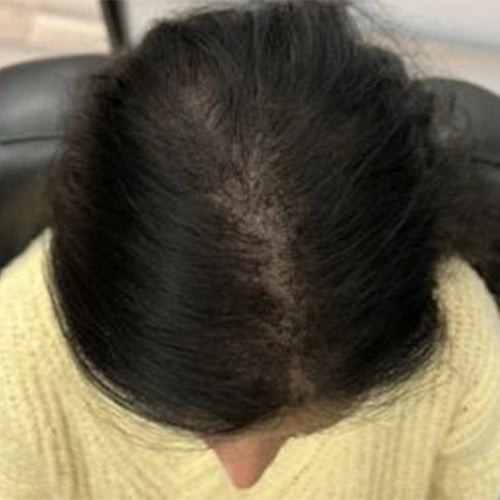 Hair_Fall_After