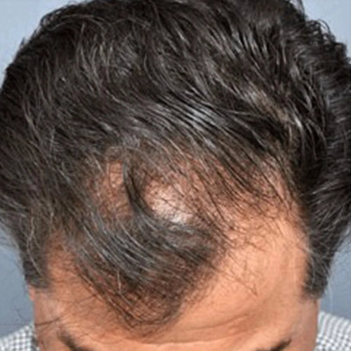 Hair_Fall_Before