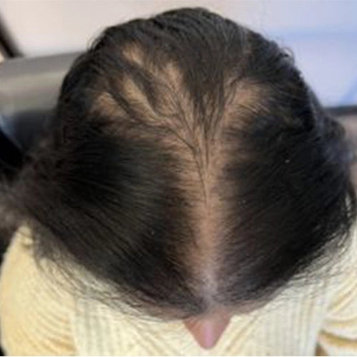 Hair_Fall_Before